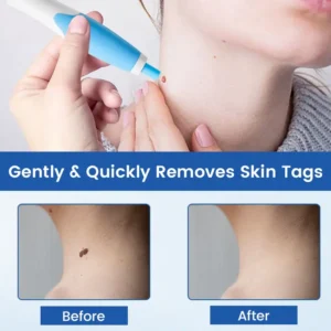 Ceoerty™ SkinTagFix Home Treatment Pen