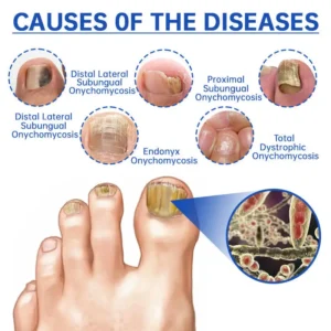 QIAWI™ PureNail Fungus Laser Device